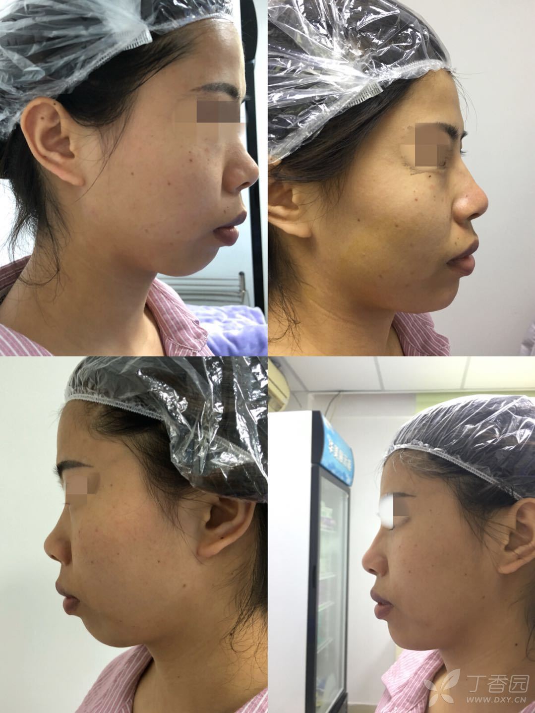 【讨论】玻尿酸隆下巴,像这种下颏后缩 该怎么打?