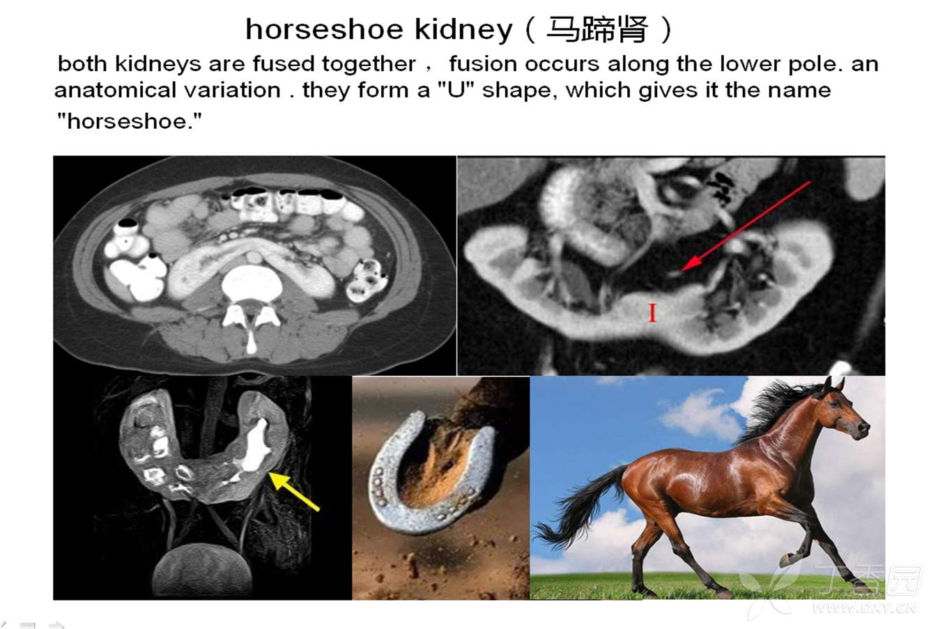 马蹄肾与正常肾图片图片