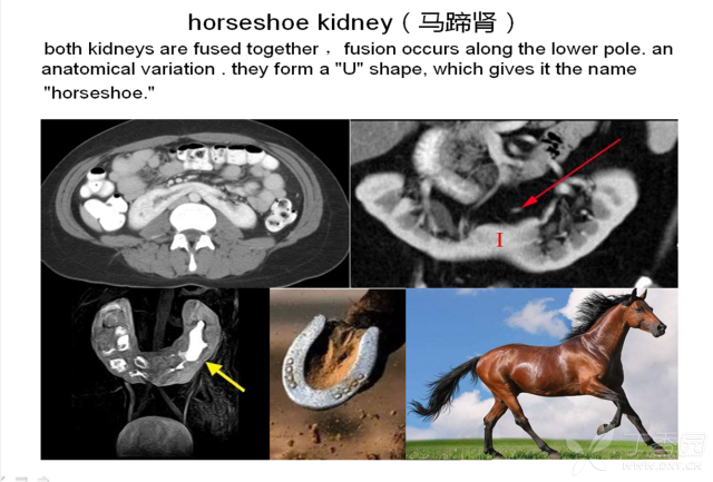 马蹄肾人均寿命_马蹄肾与正常肾图片