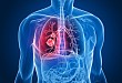 有没有不治疗的肺癌患者也能活过五年的？