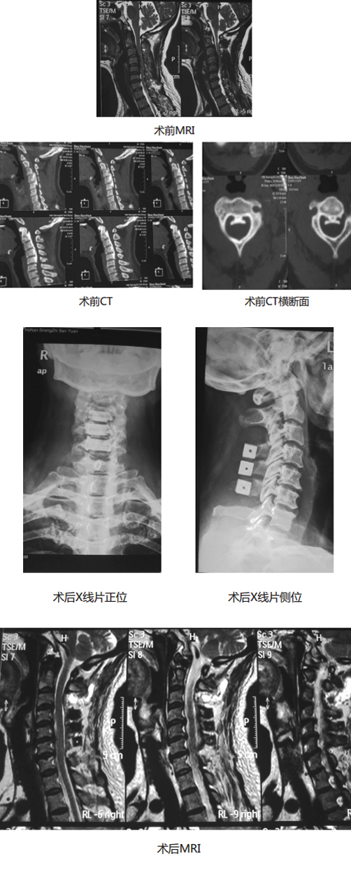 颈椎后路双开门手术图图片