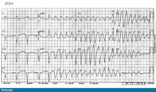 Желудочковая тахикардия фото
