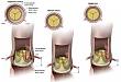 瓣叶切割技术（BASILICA）预防 TAVR 瓣中瓣术后冠脉闭塞