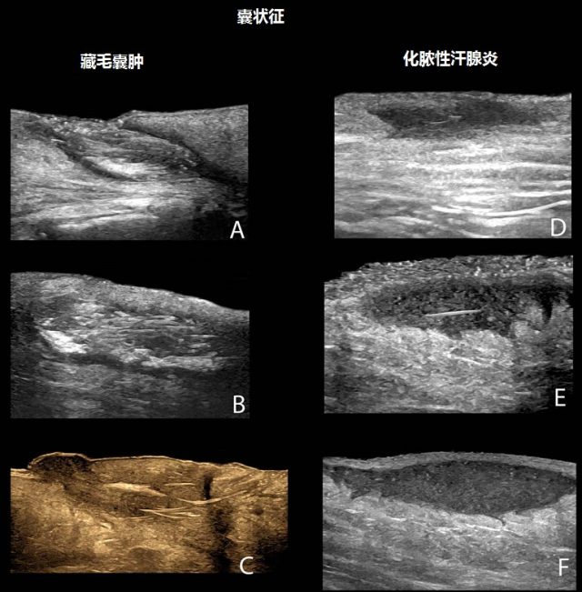 藏毛囊肿和化脓性汗腺炎的声像图特征