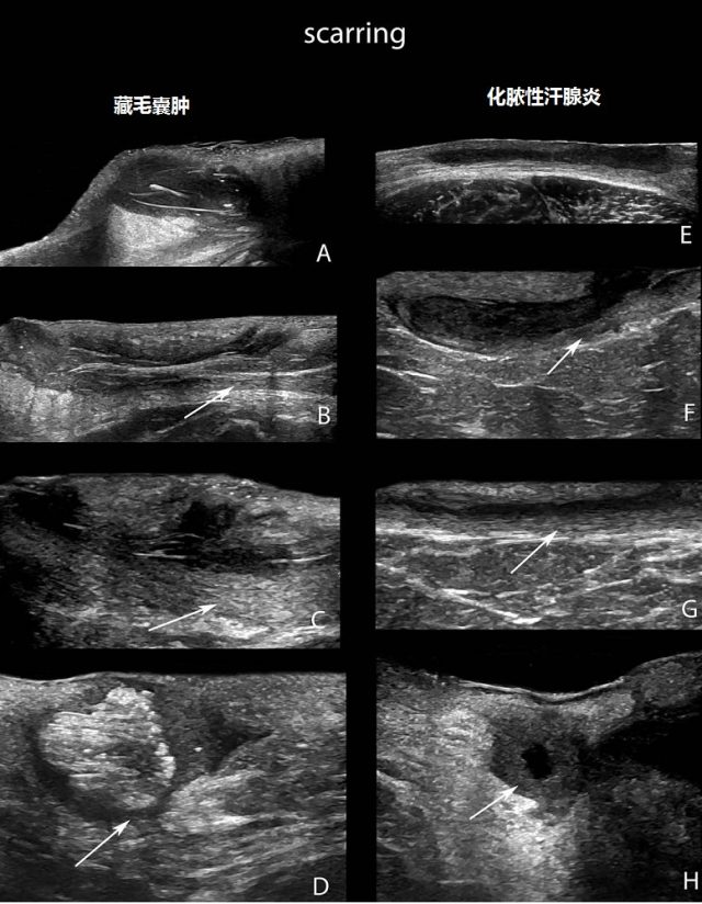 藏毛囊腫和化膿性汗腺炎的聲像圖特徵