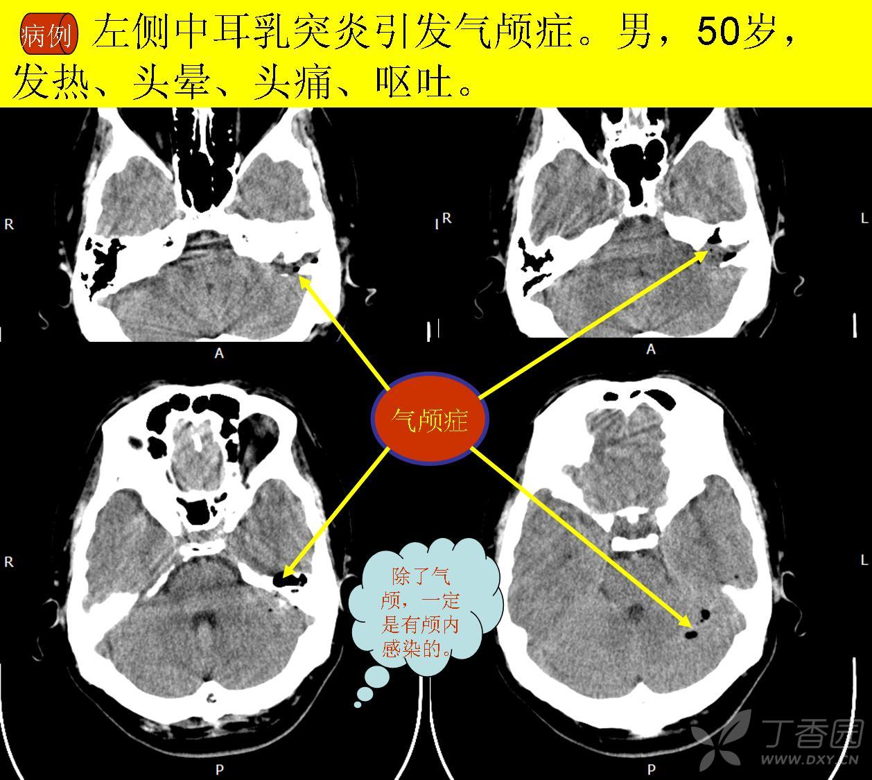 左侧中耳乳突炎引发气颅症.