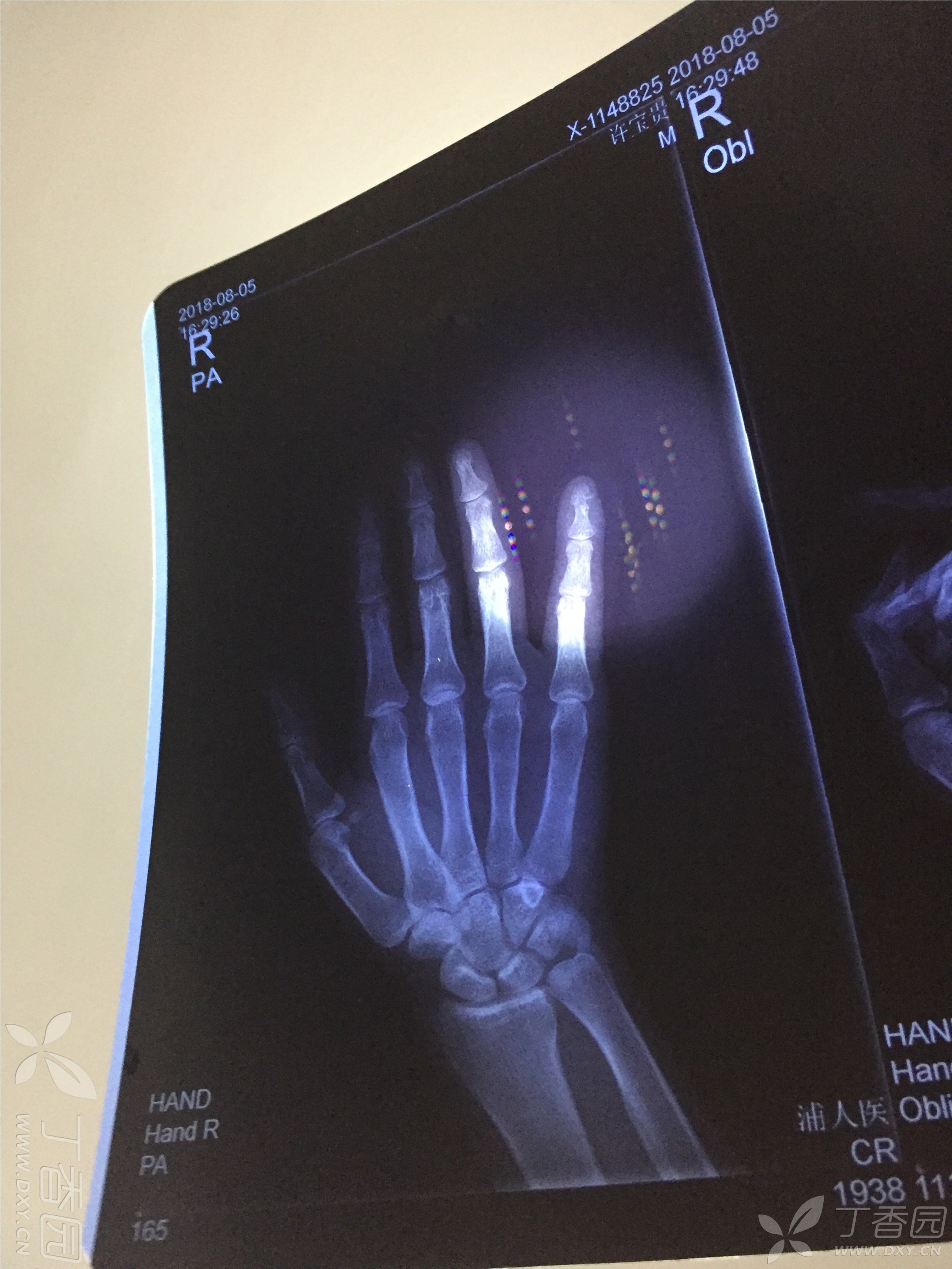 右小指指末关节骨折,请各位医生看看能恢复成原来的样子吗 dxy
