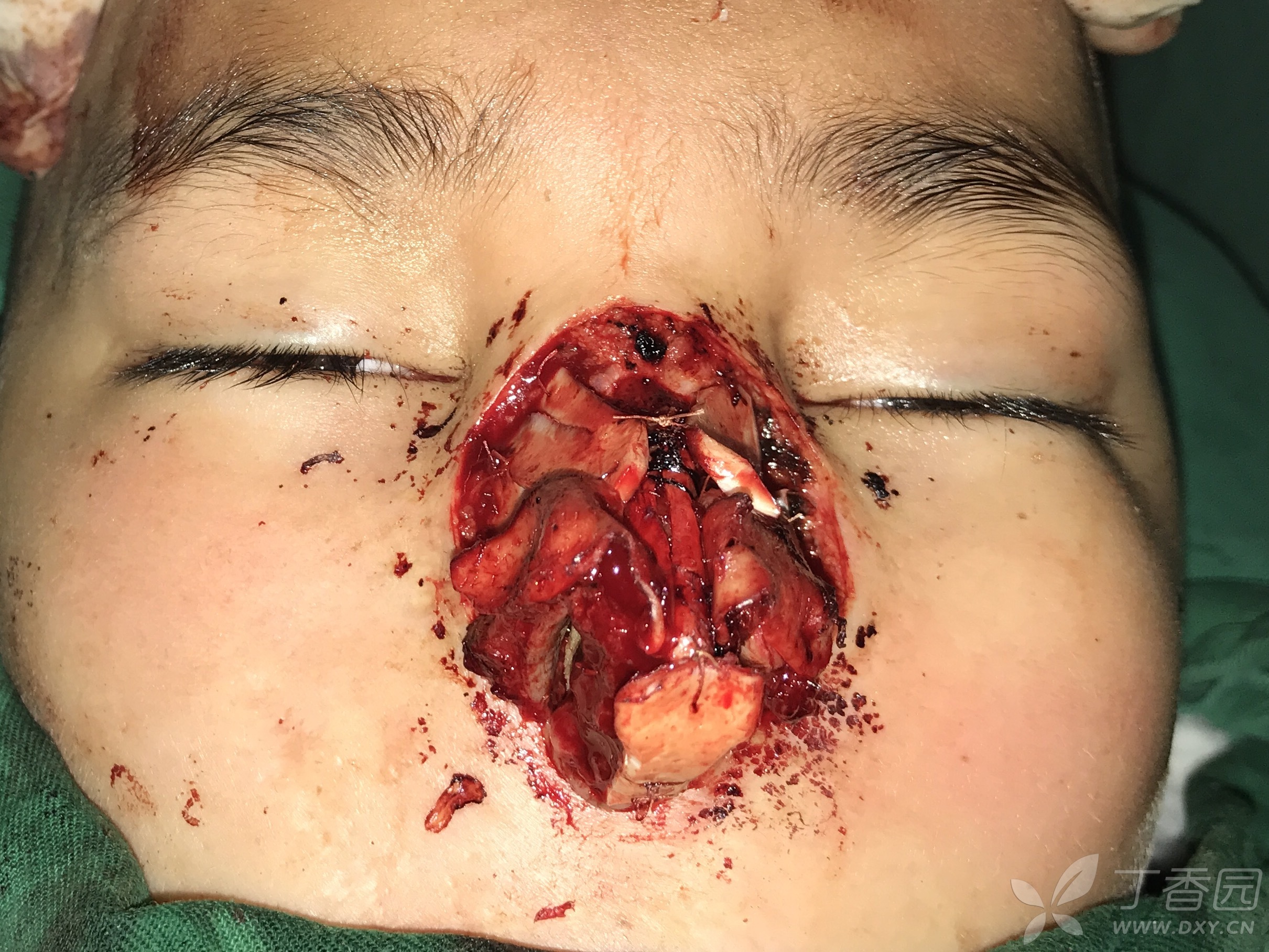 【讨论】三期额旁皮瓣次全鼻重建 - 修复重建和烧伤整形 -丁香园论坛