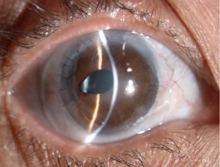 眼科专业讨论版 眼表/角巩膜病 关于角膜诊断? 1,角膜变性?