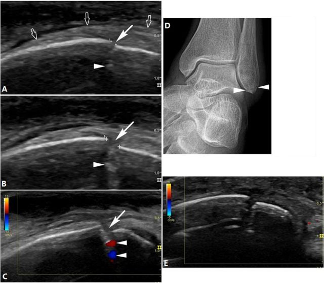 5 个病例带你学会足踝部骨折的超声诊断技巧