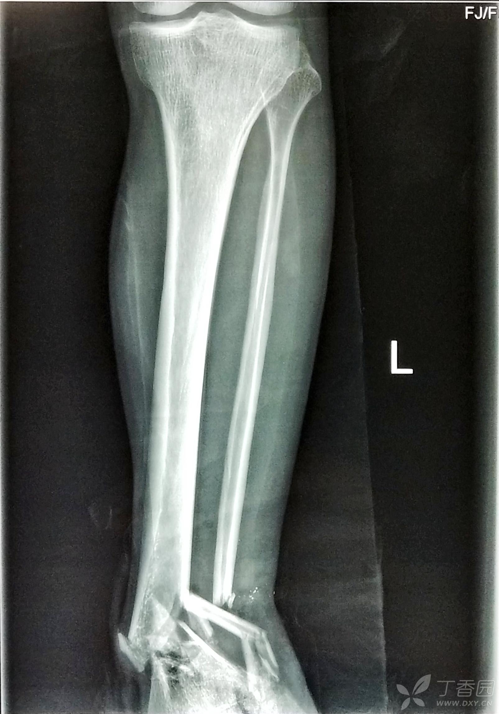 黄骨头踝关节手术日记 开放性粉碎性pilon骨折合并腓骨下段粉碎性骨折一例 骨科专业讨论版 丁香园论坛