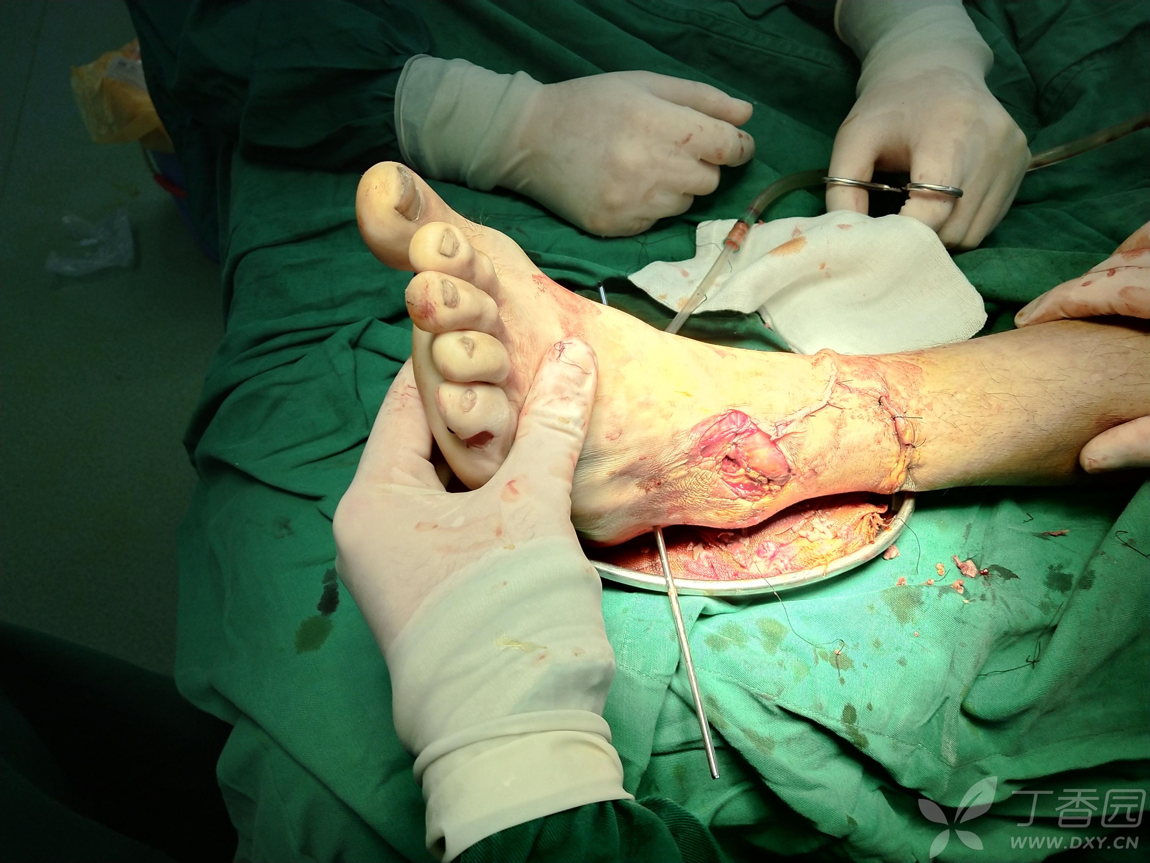 急诊手术行清创缝合vsd覆盖引流 跟骨骨牵引术