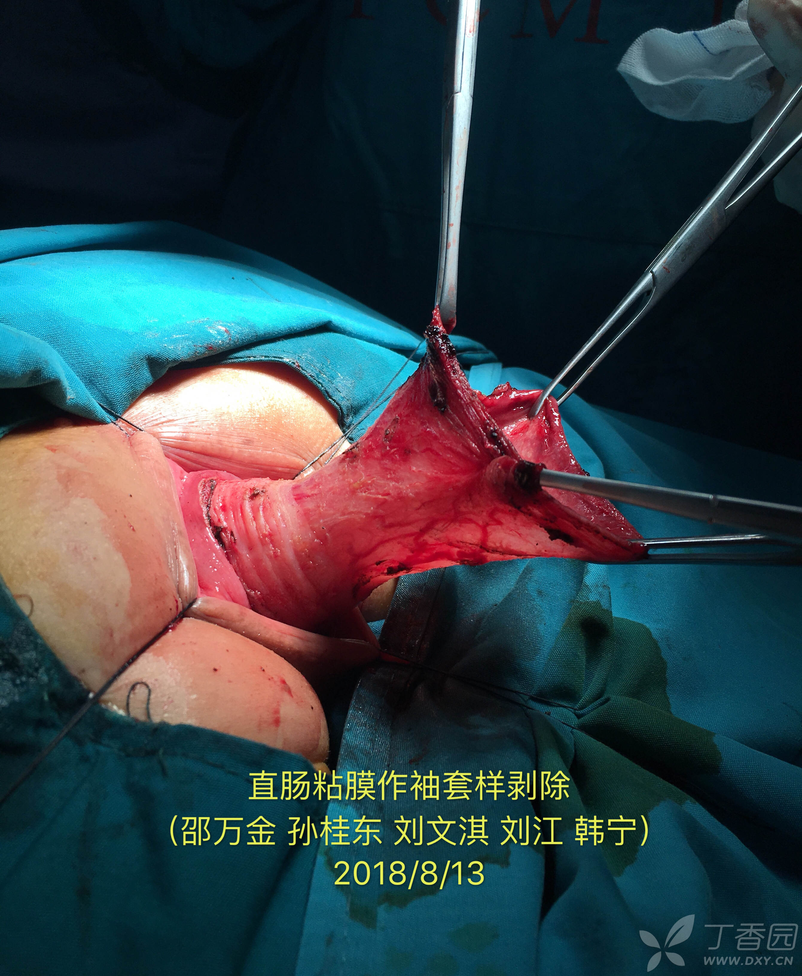 邵万金直肠脱垂delorme手术演示