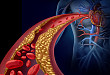 Medscape 精选 | 房颤和经皮冠状动脉介入术