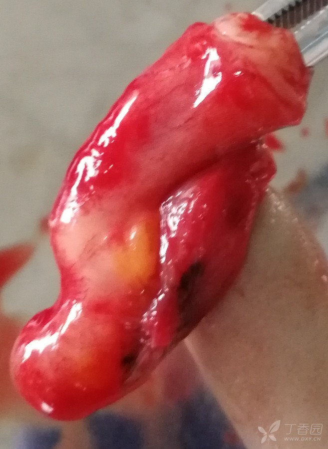 腹腔包裹性积液