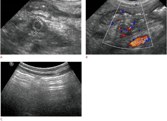 继发性阑尾炎 儿童继发性阑尾炎的超声特征