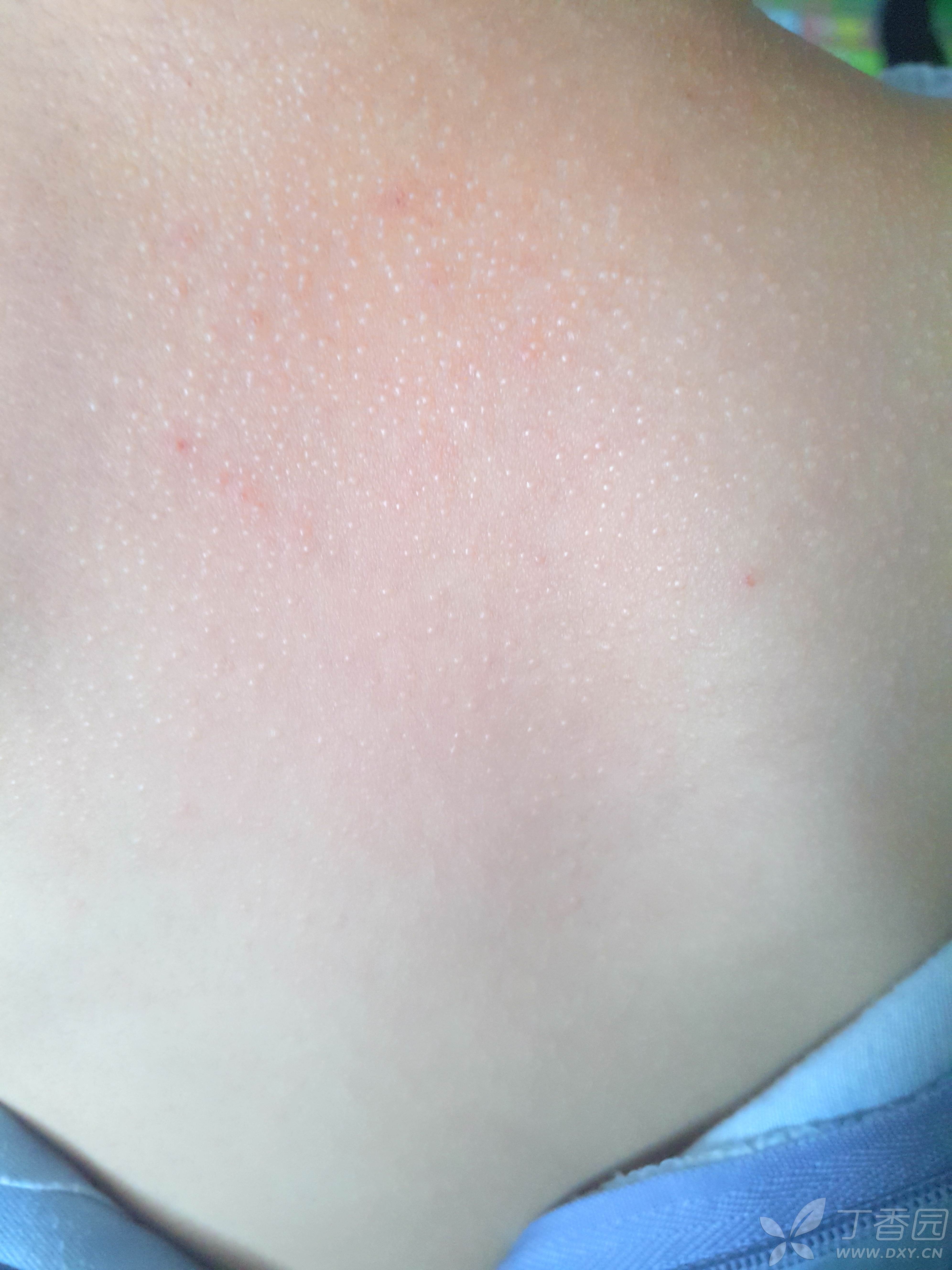 请教各位老师,女儿皮肤上的小疹子是什么?