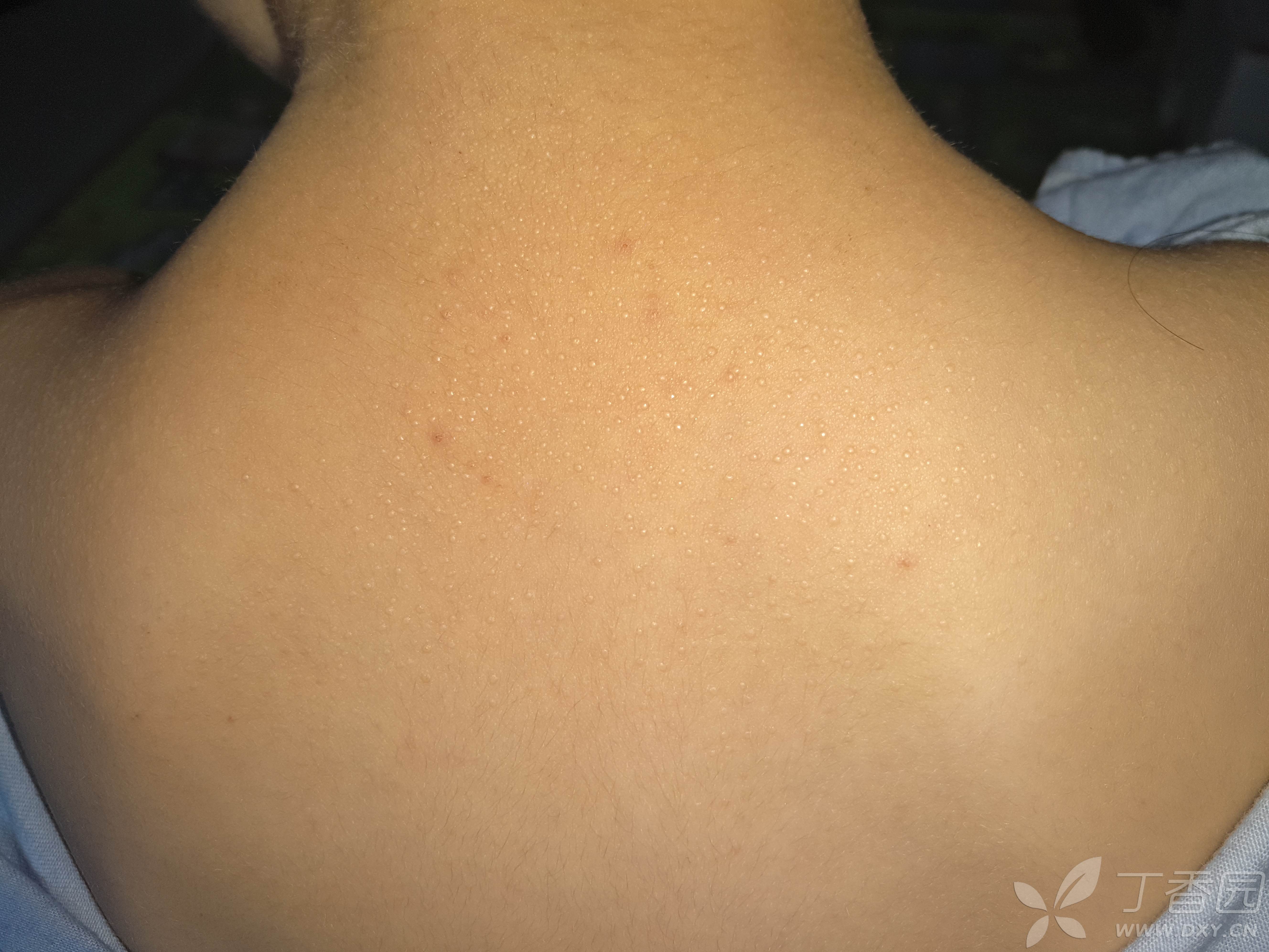 请教各位老师,女儿皮肤上的小疹子是什么?