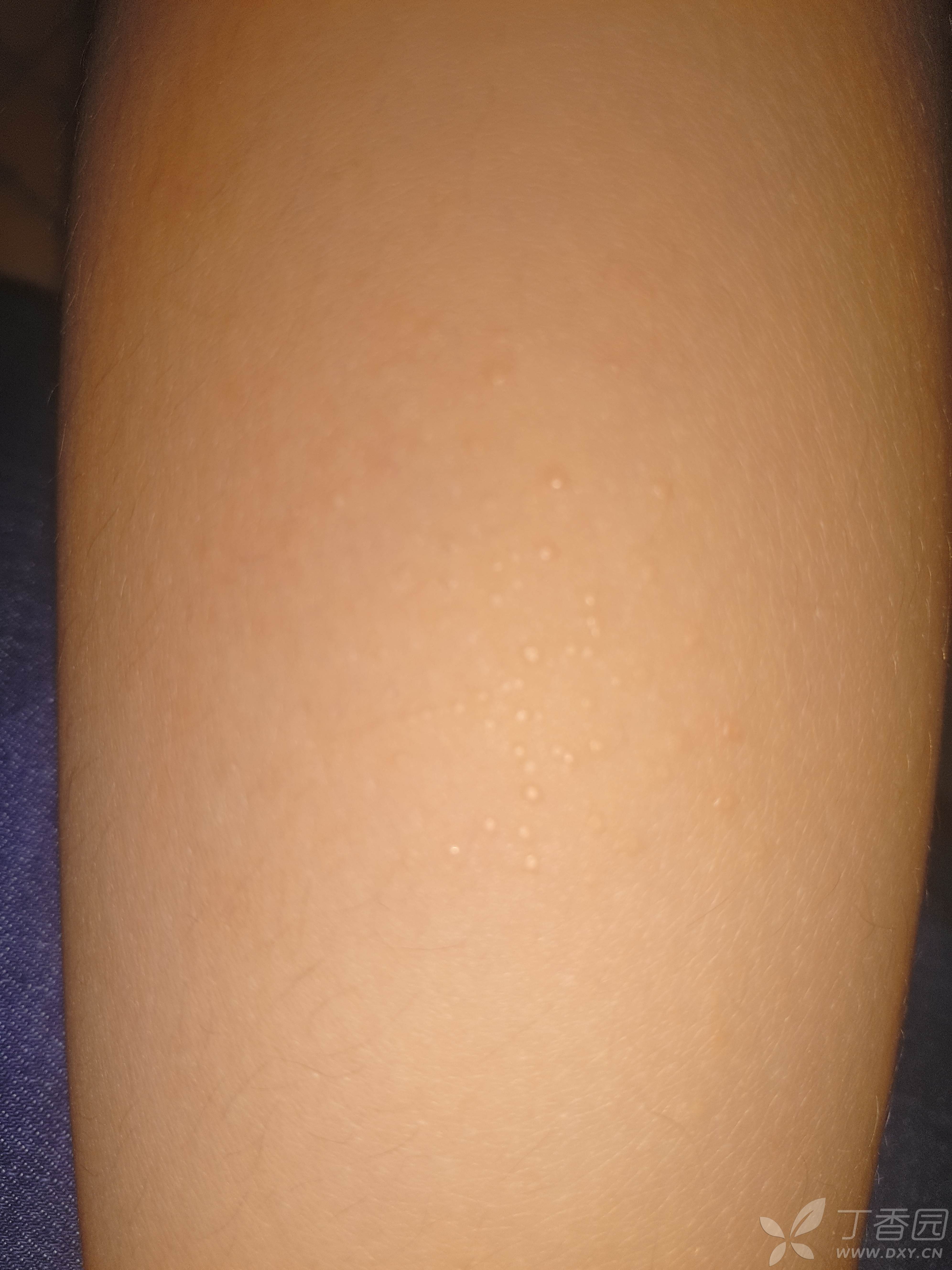 请教各位老师,女儿皮肤上的小疹子是什么?