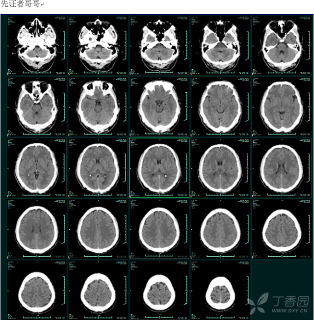 典型头颅CT对称性钙化表现--可疑1家系家族性