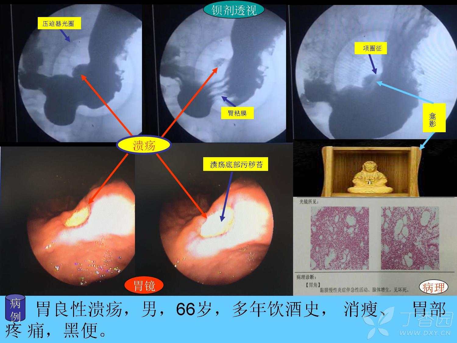 胃良性潰瘍.