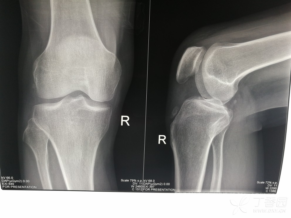 是韧带钙化?还是什么?胫骨结节的话,应该靠下吧