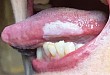 精彩病例：口腔扁平苔藓患者的舌部白斑