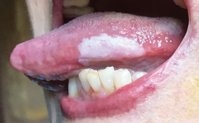 口腔白斑早期图舌头图片