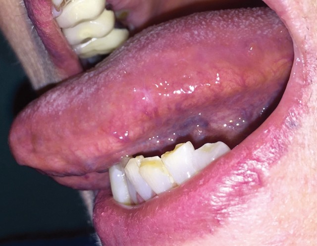 舌白斑症状图片