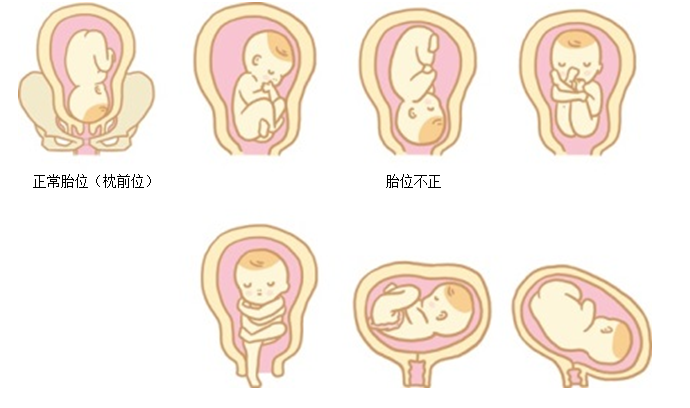 各种胎位图片图片