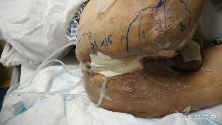 求助:会阴部大面积皮肤软组织坏死该如何处理. [病例帖]