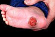 罕见病例：可以自愈的足部先天性肿物
