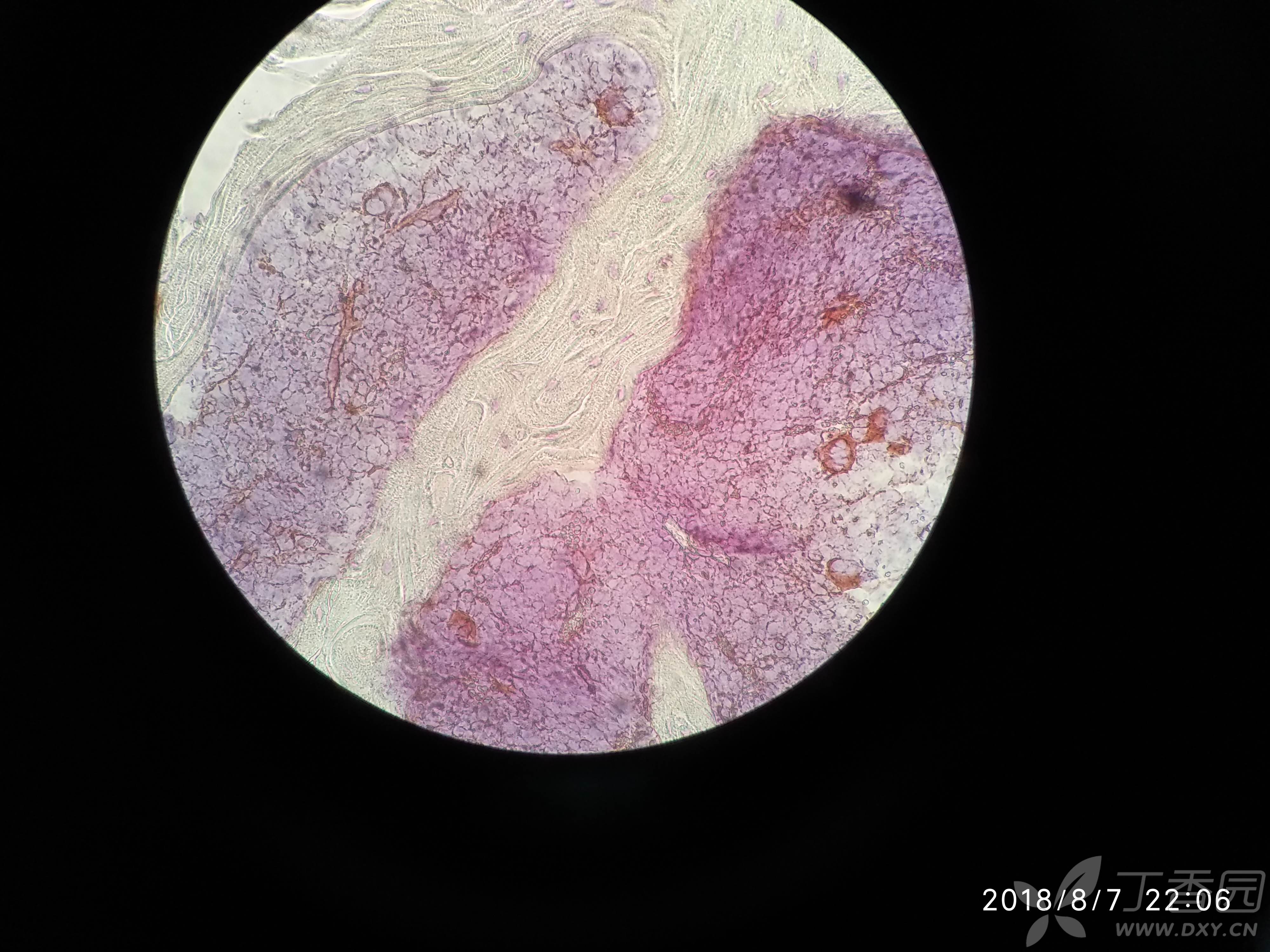 求助:股骨脱钙做石蜡切片ihc苏木素染色之后骨髓腔整片蓝染,见不到