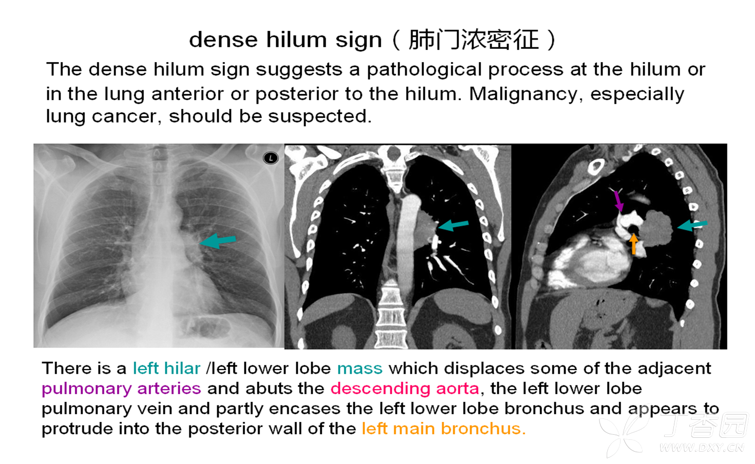 肺门浓密征:在正位胸片上肺门增大,密度增高 ,暗示有病变位于肺门或其