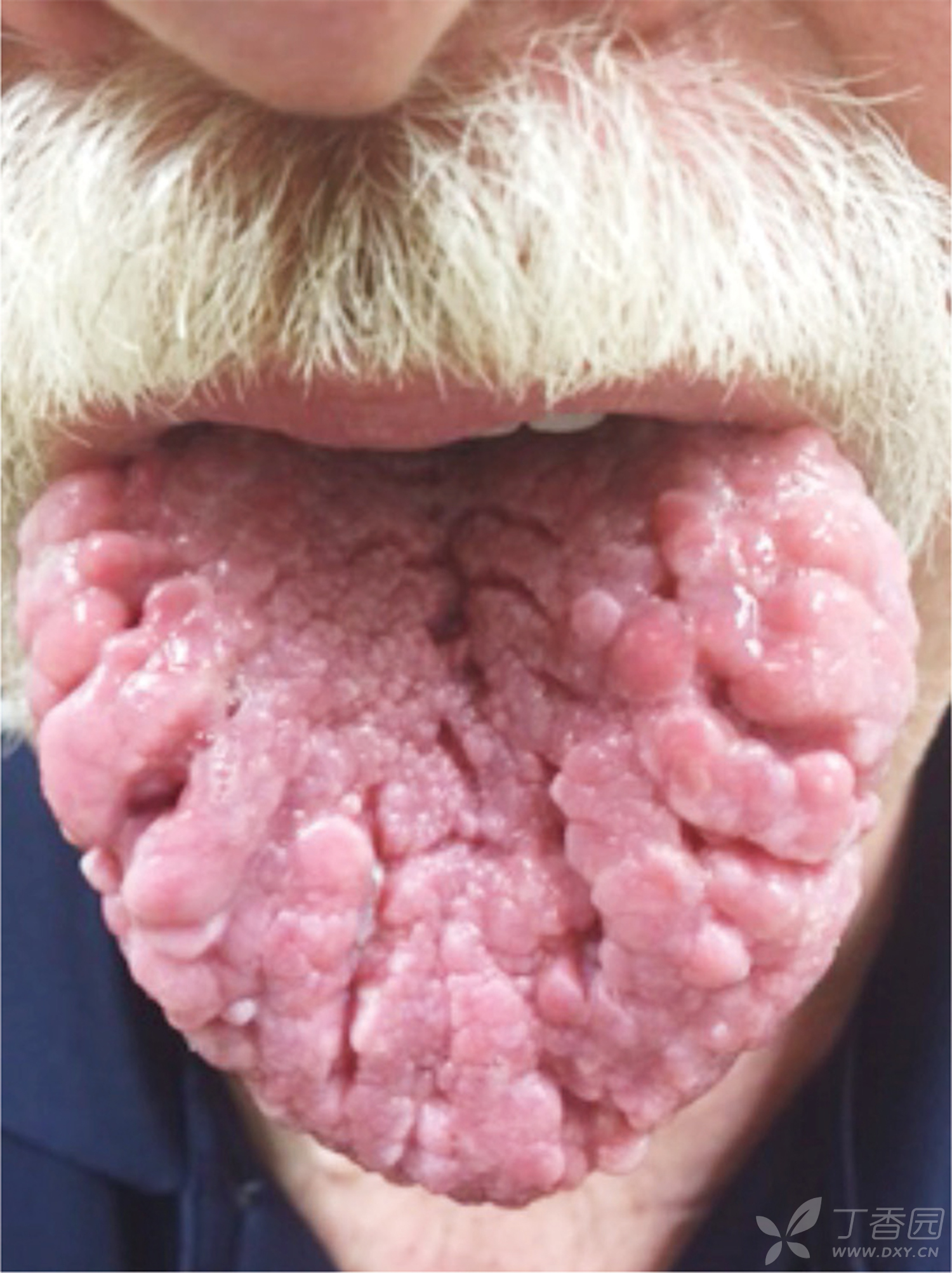 舌头黑色素瘤图片