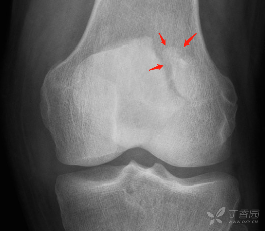 典型骨病系列 13 (二分髌骨 vs 骨折) [病例帖]