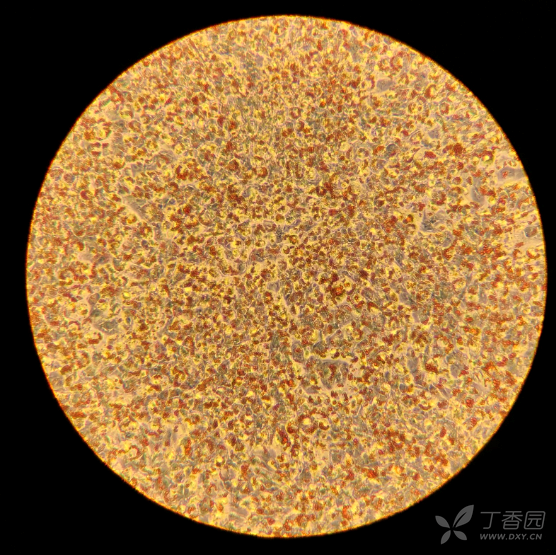 可能涉及到敏感图片,点击后可查看      这一张做的油红o染色,可以