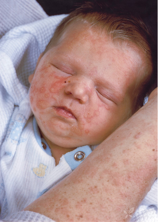宝宝带状疱疹图片
