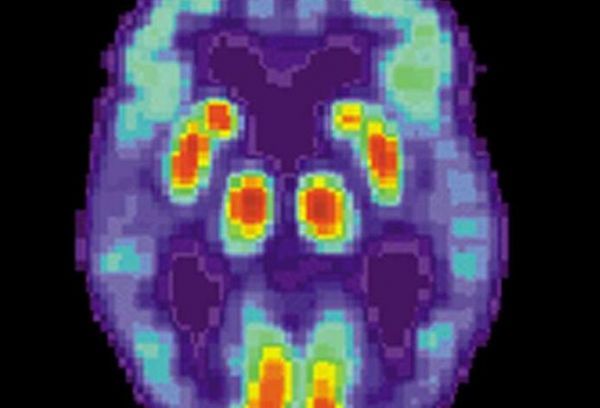 【前沿咨询】JMB：肝病药物熊去氧胆酸或能有效改善阿尔兹海默病疾病症状