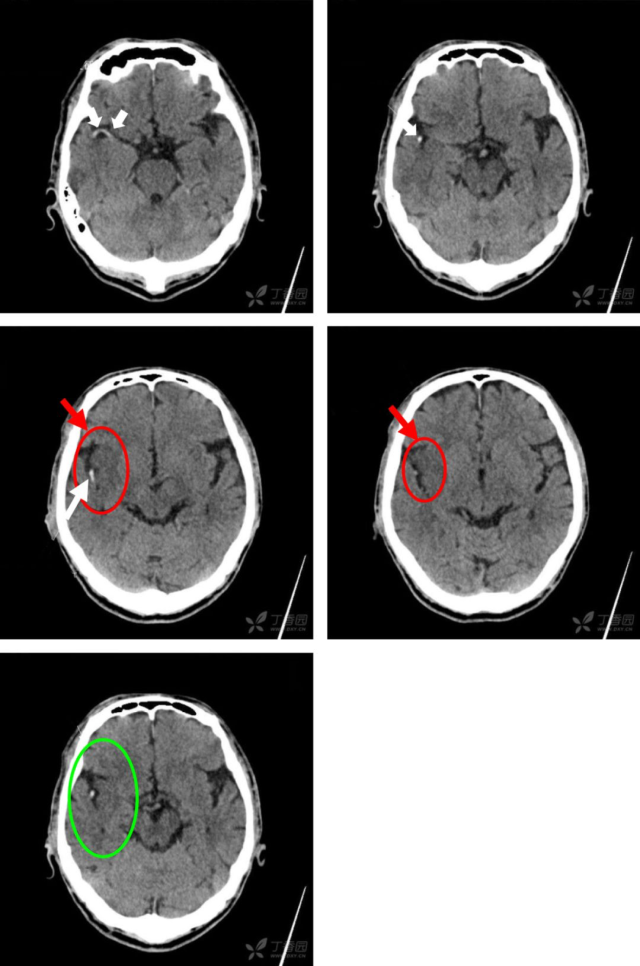 急性脑梗CT 急性脑梗 CT 读片，看完这 6 例就会了