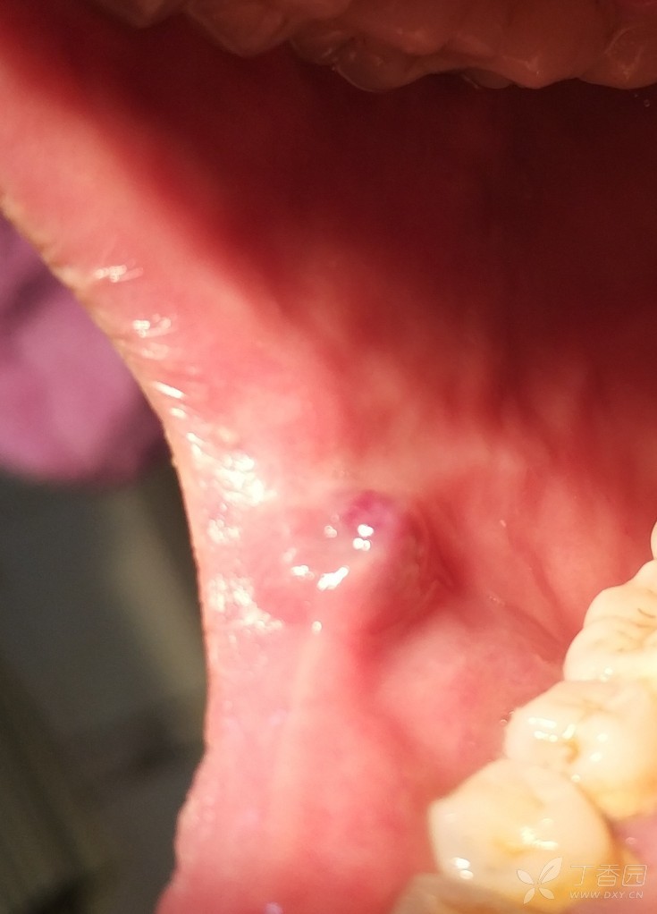 口腔内壁有红血点图片图片