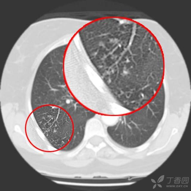 总在肺结核影像上「翻车」？老司机带带你 - 丁香园