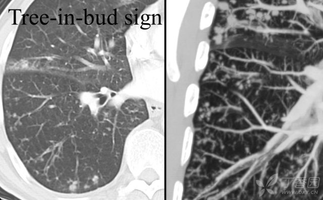 树芽支气管树Tree_in_bud_sign.jpg