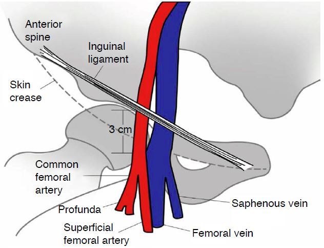 图 1 股动脉和股静脉解剖示意图