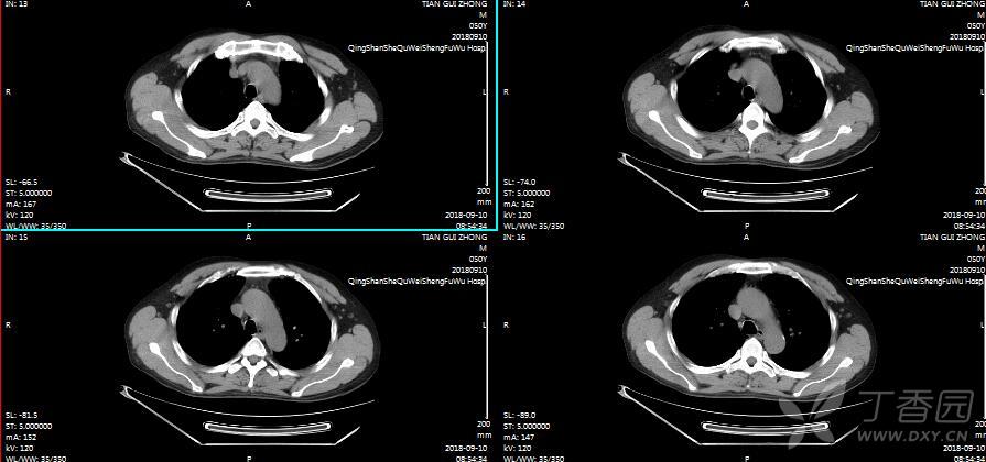 男,50岁,各位老师帮忙看下右肺门,谢谢