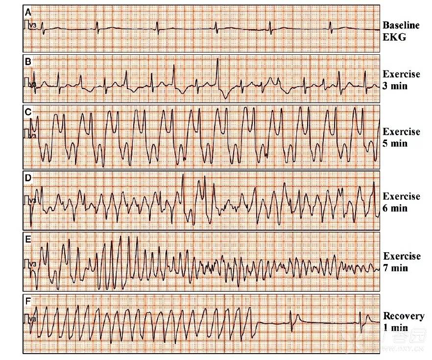 儿童儿茶酚胺敏感性多形性室性心动过速 一例报告
