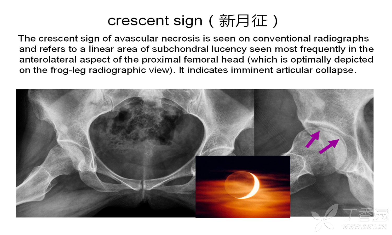 crescent sign(新月征[病例帖]