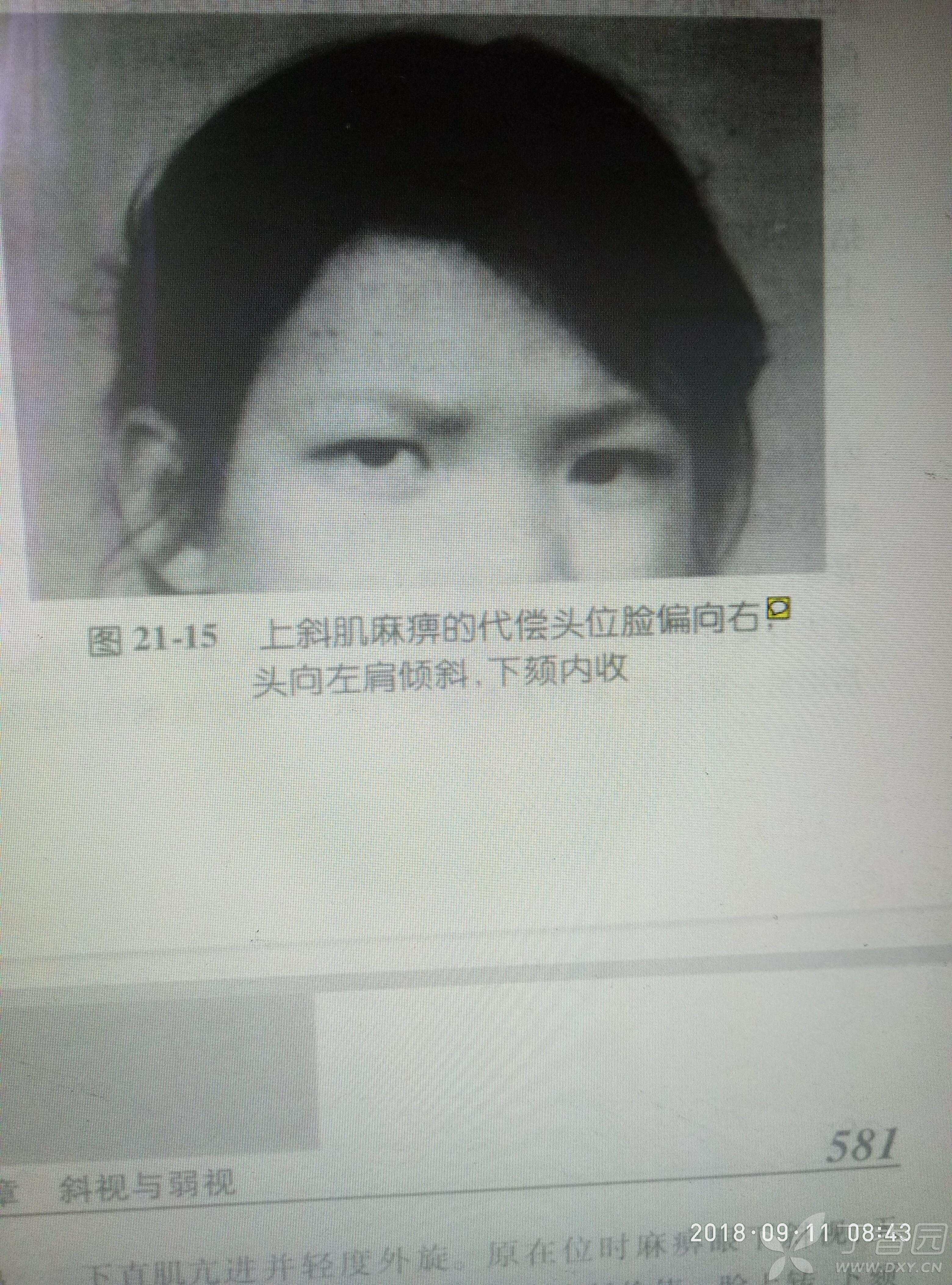 对《实用眼科学》第三版(电子版)代偿头位的讨论