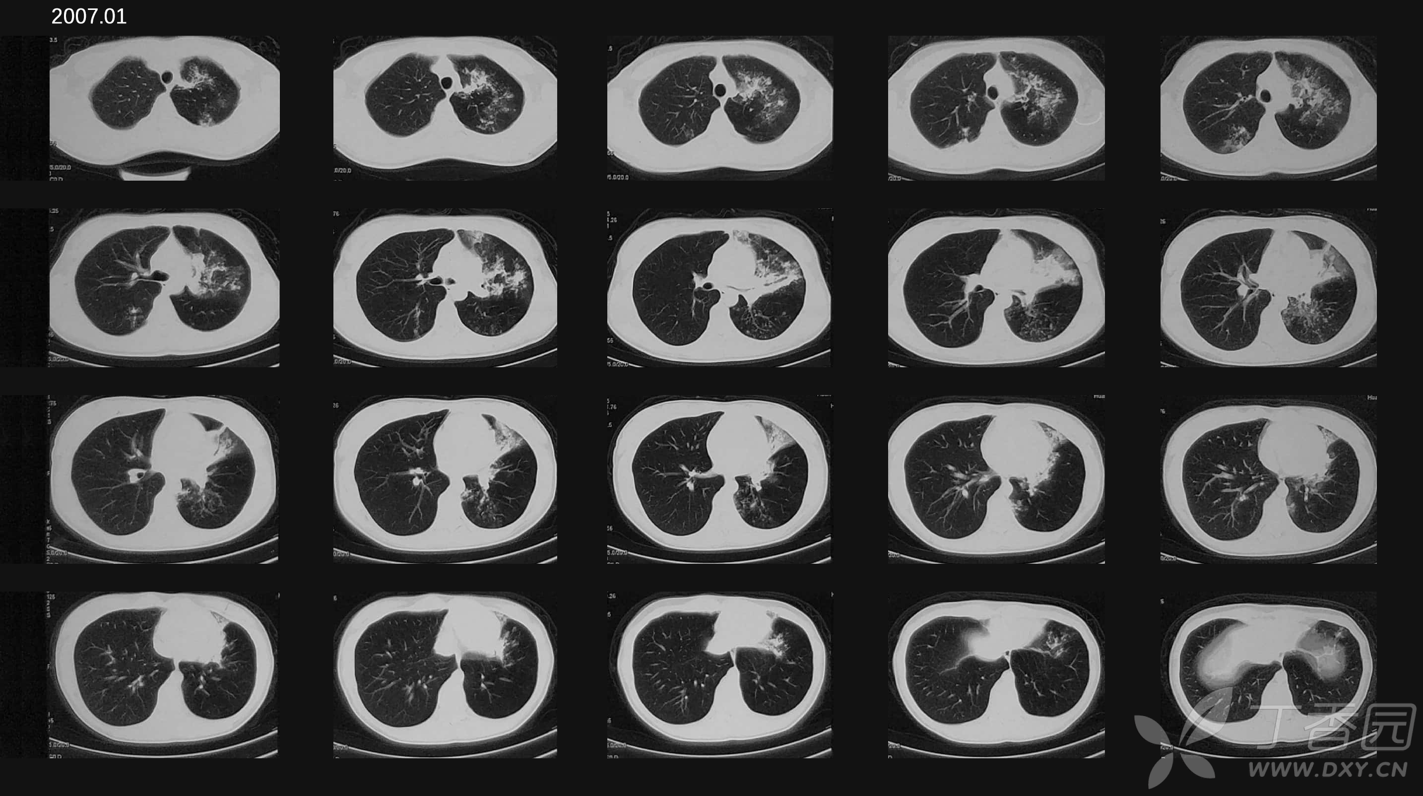 谁动了我的左肺? [病例帖]