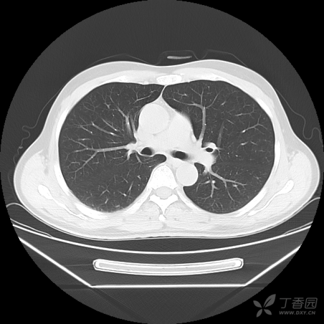 回肠末端肠壁增厚并腹腔淋巴结肿大,大家帮忙分析一下,有病理